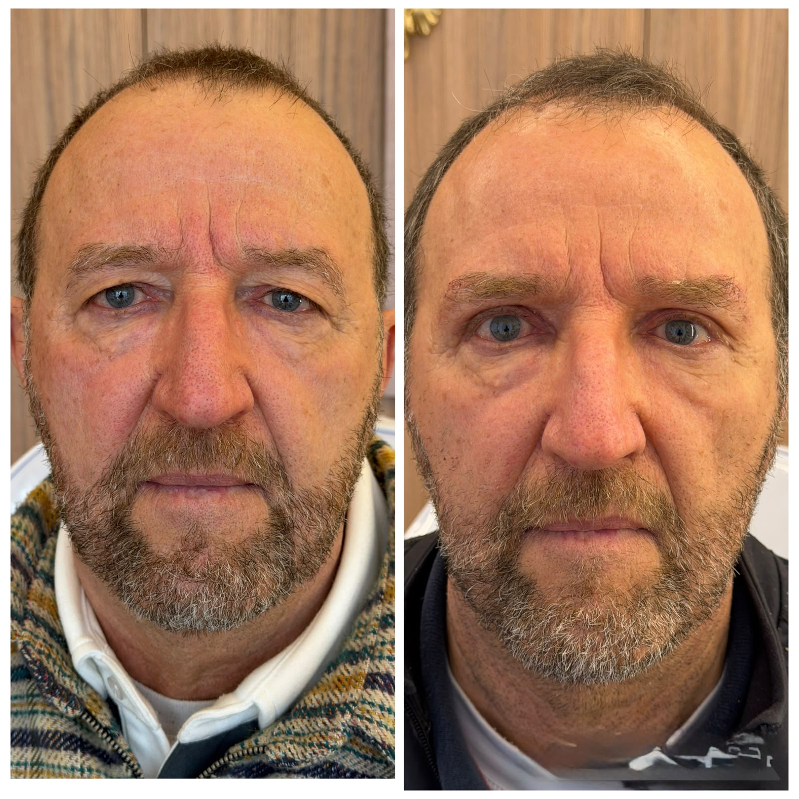 Antes e Depois Masculino 2
