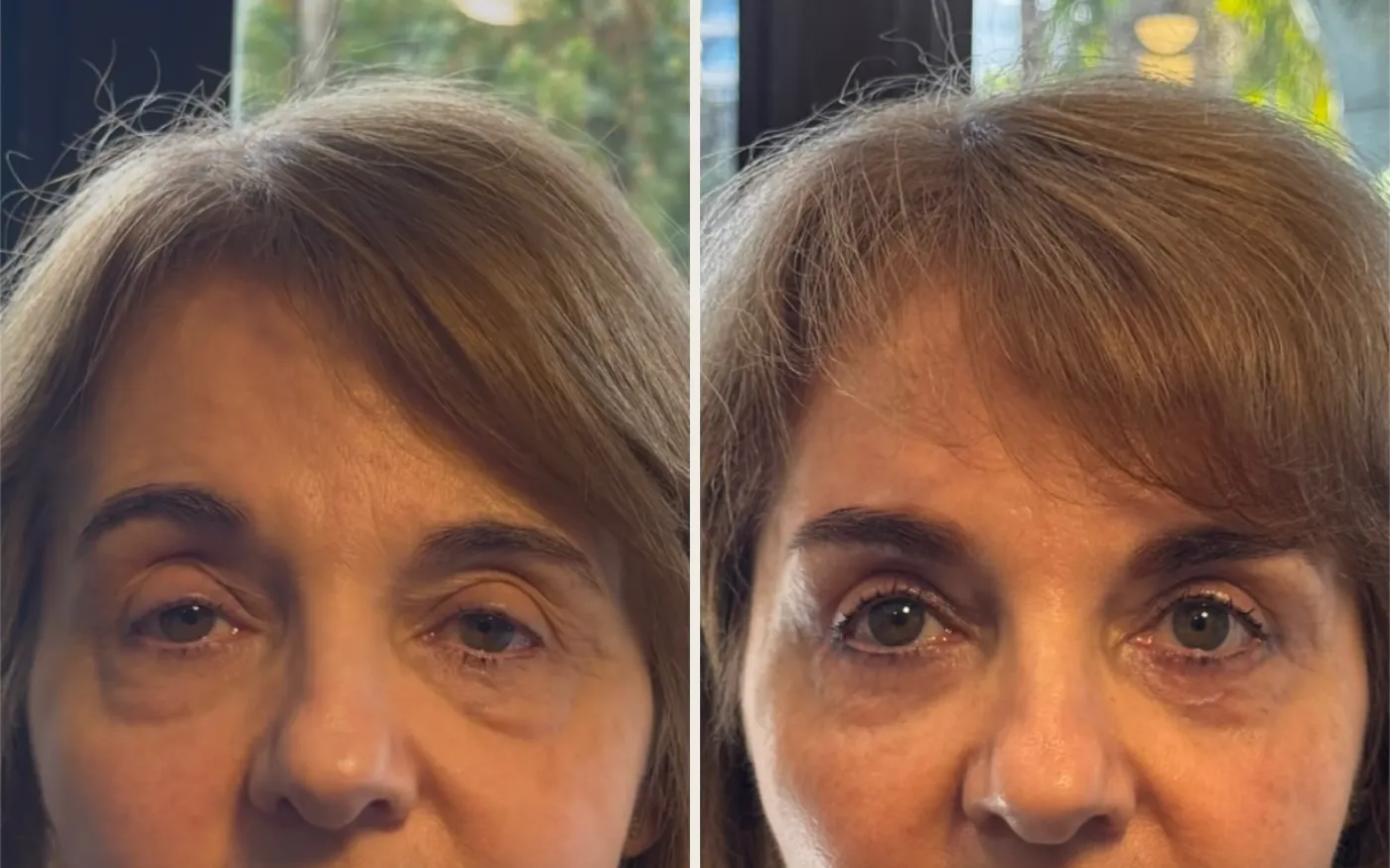 Antes e Depois - Caso 1