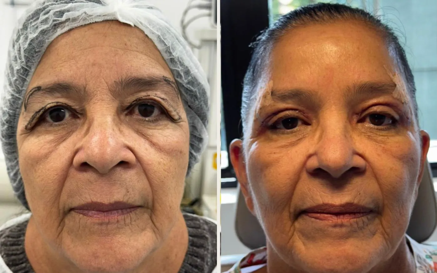Antes e Depois - Caso 3