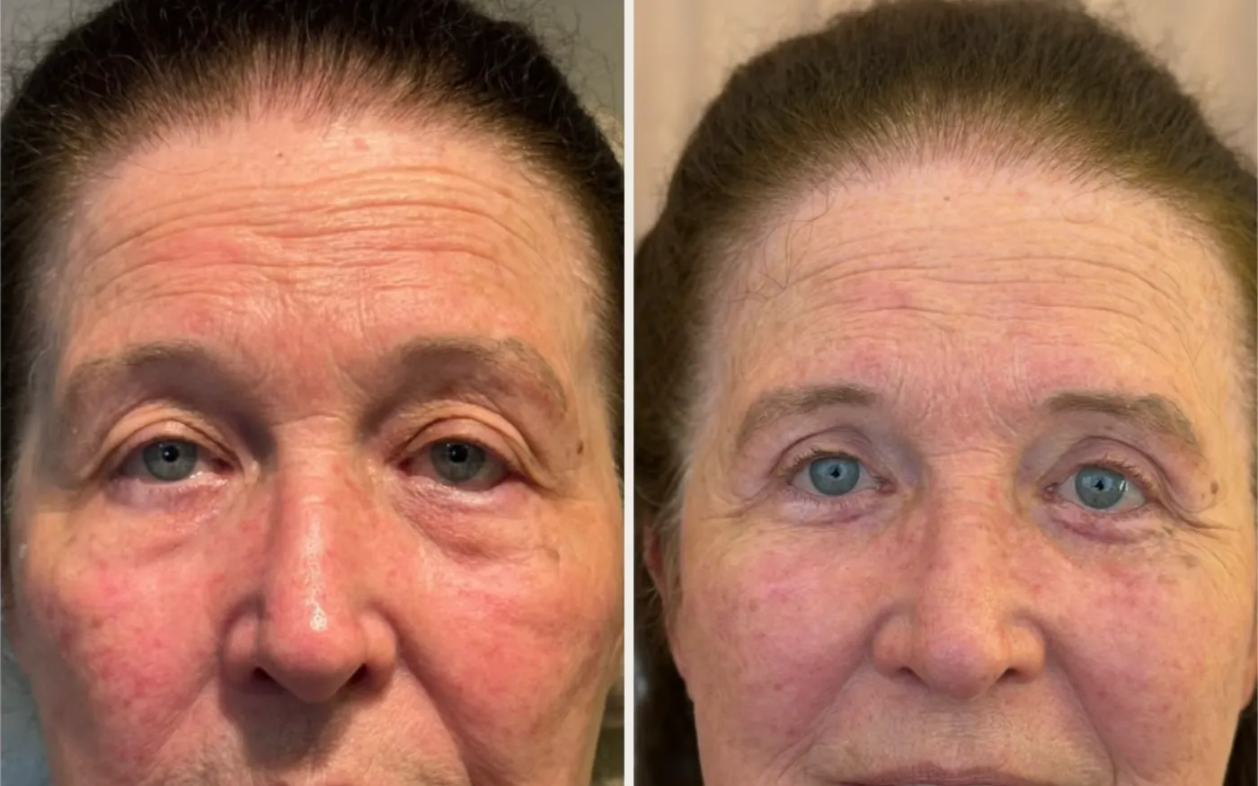 Antes e Depois - Caso 4